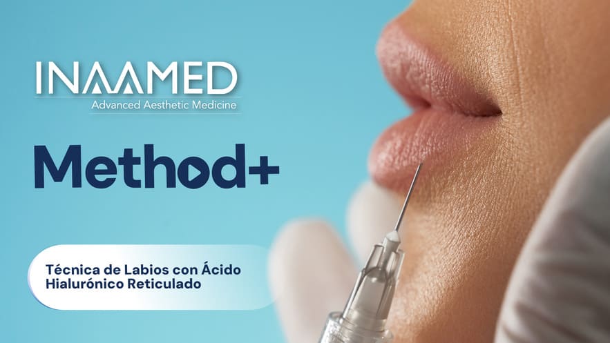Técnica de Labios con Ácido Hialurónico Reticulado