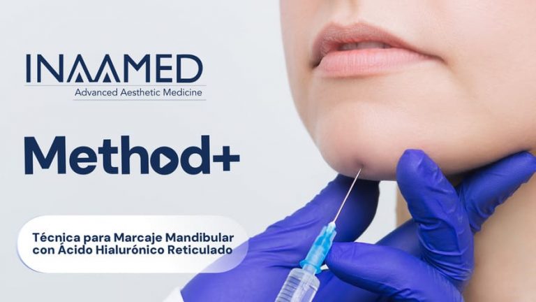 Técnica para Marcaje Mandibular con Ácido Hialurónico Reticulado