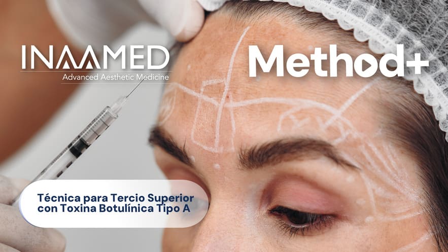 Técnica para Tercio Superior con Toxina Botulínica Tipo A