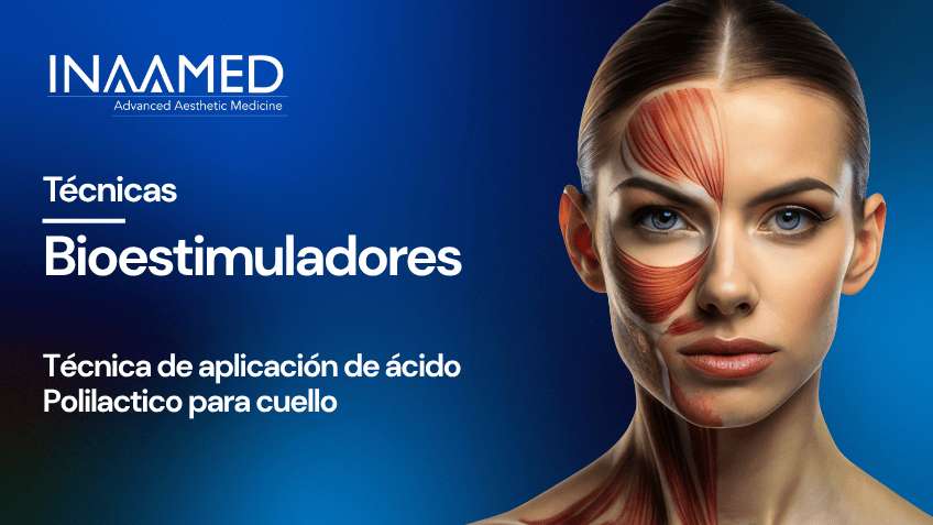 Bioestimuladores PLLA Cuello